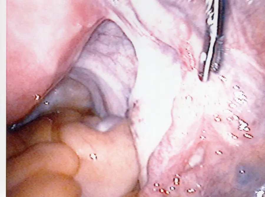 Fallopian Tube Missing Segment Tubal Ligation