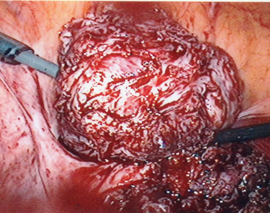Intramural Fibroid Removed Laparoscopic Myomectomy