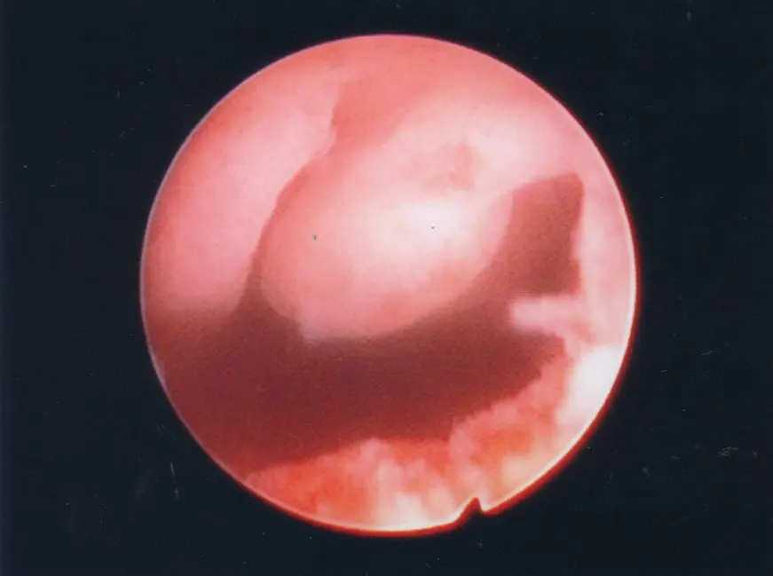 Polyp Inside Uterine Cavity
