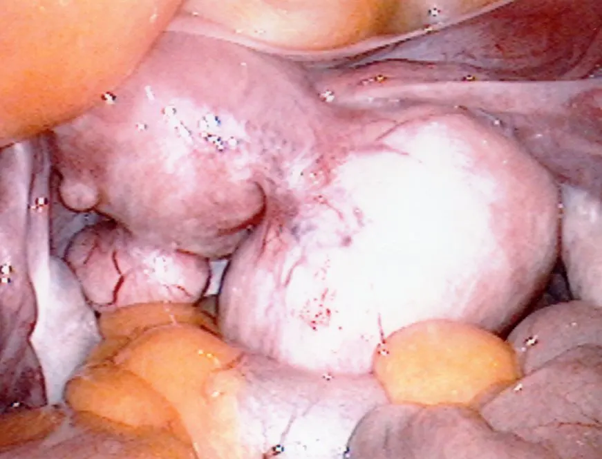 Tow Pedunculated Fibroids Attached to Uterus Surface