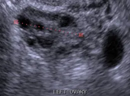 Ultrasound of a Normal Ovary