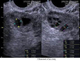 Ultrasound of an Ovary