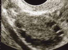 Ultrasound of Polycystic Ovary, Classic Necklace Sign