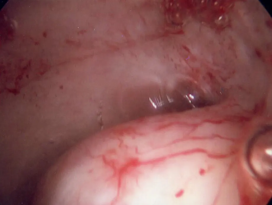 Uterine Fibroid in Uterine Cavity