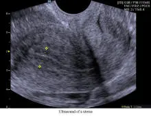 Uterus Ultrasound